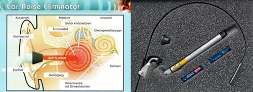 Tinnitus ohrlasertherapie - tinnitus,